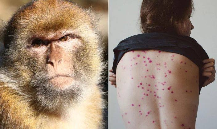 В Україні підтвердили третій випадок віспи мавп, – повідомив головний санітарний лікар Кузін