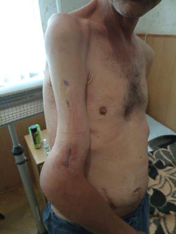 Рука защитника Азовстали Михаила Дианова после ранения и 4 месяцев российского плена
